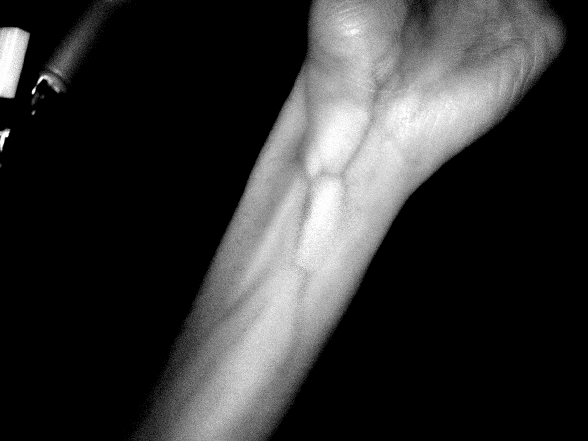 Screencap of veins in an arm using a pi camera module, IR filter and lights.